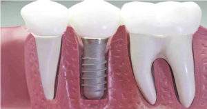 Ventajas interesantes de los implantes dentales
