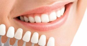 10 cosas que debes saber sobre el blanqueamiento dental