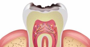 15 causas que provocan caries dentales