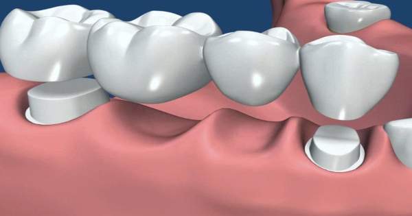 3 diferentes tipos de puentes dentales