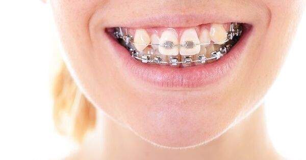 3 formas de corregir los dientes deformes y torcidos