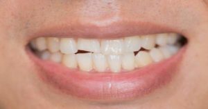 3 formas de reparar un diente quebrado o roto