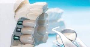 3 tipos de puentes dentales para el paciente