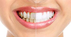 3 trucos caseros para blanquear tus dientes