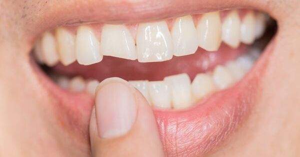 5 causas que producen dientes chuecos o desalineados