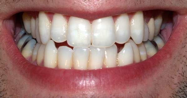 7 problemas como consecuencia de los dientes torcidos