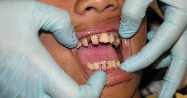 Caries dentales causadas por brackets ¿Realidad o Mito?