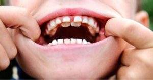 ¿Cómo tratar un diente en el paladar?