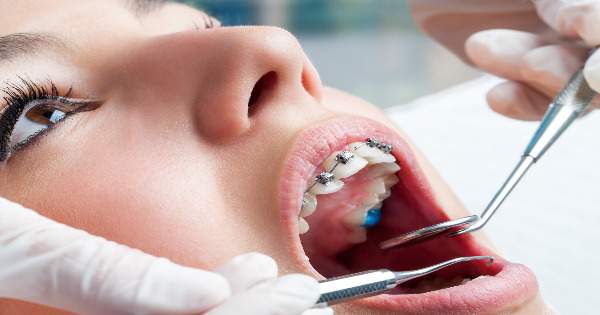 Brackets: Que Esperar Cuando Visitas Al Dentista