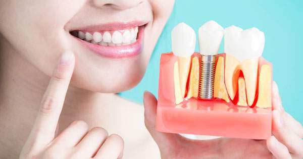 Consejos para elegir implantes dentales
