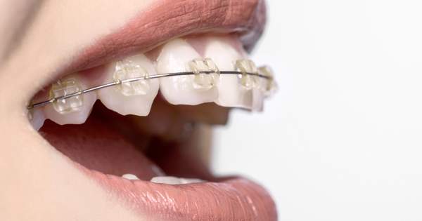 Consideraciones que debes conocer sobre la ortodoncia