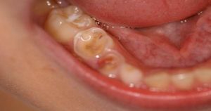 ¿Cuánto conoces sobre la erosión dental?