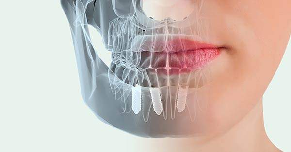 Descubre los motivos ideales para colocarte implantes dentales