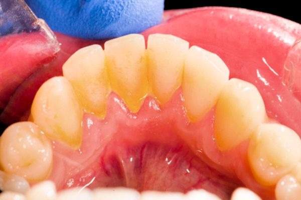Diferencias entre la placa y el sarro dental