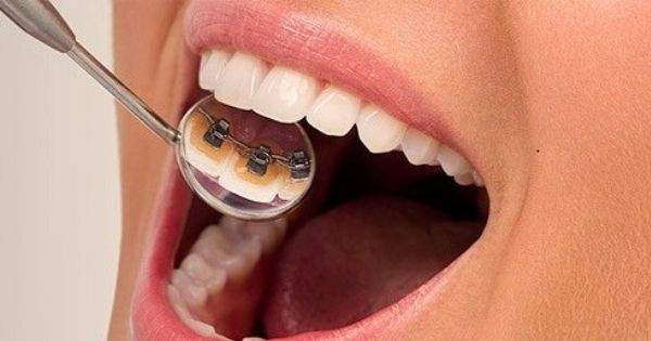 Innovación en tratamientos dentales brackets linguales