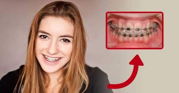 La ortodoncia previene las enfermedades periodontales
