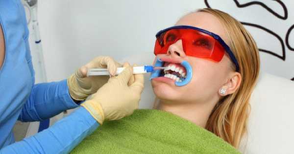 Los blanqueamientos dentales tienen efectos secundarios