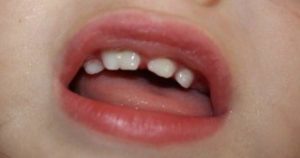 Mi hijo tiene dientes de leche dobles ¿Qué debo hacer?