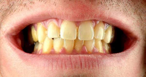 ¿Por qué los dientes se ponen amarillentos?