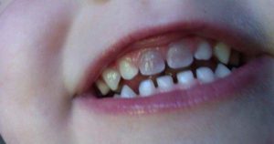 ¿Por qué mi hijo tiene un diente descolorido?