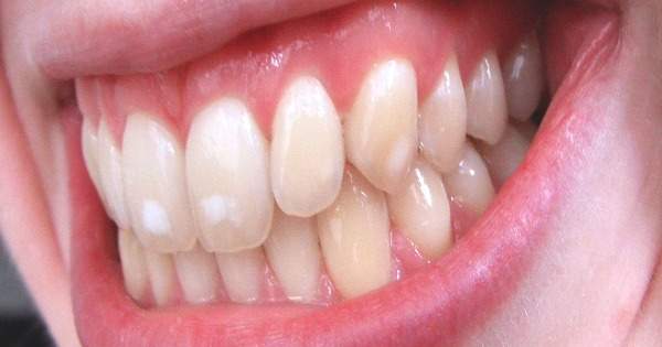 Qué es y cómo prevenir la fluorosis dental