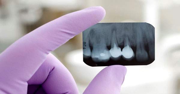¿Qué tan seguras son las radiografías odontológicas?