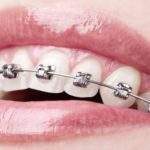 ¿Se pueden colocar brackets en las cara internas de los dientes?