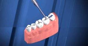 Selladores dentales, qué son y cómo funcionan