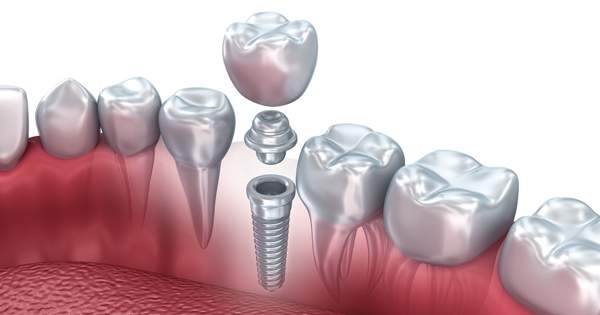 Solución a preguntas comunes sobre los implantes dentales